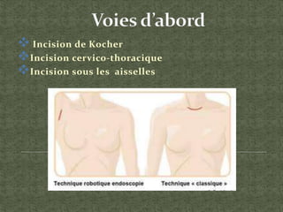  Incision de Kocher
Incision cervico-thoracique
Incision sous les aisselles
 
