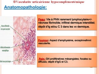 Anatomopathologie:
Peau: Vte à PNN rarement lymphocytaire+/-
nécrose fibrinoîde; infiltrat dermique interstitiel;
dépôt d’Ig et/ou C 3 dans les vx dermique.
Poumon: Aspect d’emphysème, exceptnnellmnt
vascularite.
Rein: GN prolifératives mésangiales; focales ou
diffuses; dépôt d’IgG et C3.
 