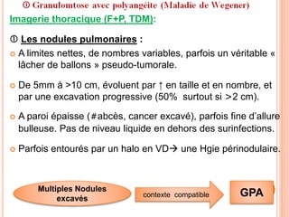 Imagerie thoracique (F+P, TDM):
 Les nodules pulmonaires :
 A limites nettes, de nombres variables, parfois un véritable «
lâcher de ballons » pseudo-tumorale.
 De 5mm à >10 cm, évoluent par ↑ en taille et en nombre, et
par une excavation progressive (50% surtout si >2 cm).
 A paroi épaisse (#abcès, cancer excavé), parfois fine d’allure
bulleuse. Pas de niveau liquide en dehors des surinfections.
 Parfois entourés par un halo en VD une Hgie périnodulaire.
contexte compatible
Multiples Nodules
excavés
GPA
 