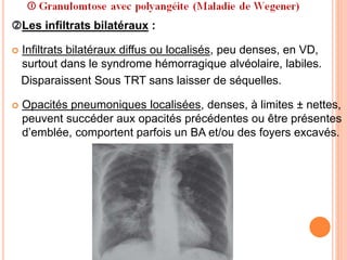 Les infiltrats bilatéraux :
 Infiltrats bilatéraux diffus ou localisés, peu denses, en VD,
surtout dans le syndrome hémorragique alvéolaire, labiles.
Disparaissent Sous TRT sans laisser de séquelles.
 Opacités pneumoniques localisées, denses, à limites ± nettes,
peuvent succéder aux opacités précédentes ou être présentes
d’emblée, comportent parfois un BA et/ou des foyers excavés.
 