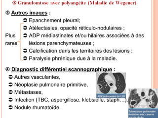  Autres images :
 Epanchement pleural;
 Atélectasies, opacité réticulo-nodulaires ;
Plus  ADP médiastinales et/ou hilaires associées à des
rares lésions parenchymateuses ;
 Calcification dans les territoires des lésions ;
 Paralysie phrénique due à la maladie.
 Diagnostic différentiel scannographique :
 Autres vascularites,
 Néoplasie pulmonaire primitive,
 Métastases,
 Infection (TBC, aspergillose, klebsielle, staph…),
 Nodule rhumatoïde.
 
