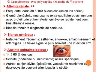  Atteinte rénale: ++
 Fréquente, dans 38 à 100 % des cas (selon les séries).
 Glomérulonéphrite nécrosante extra-capillaire pauci-immune
avec protéinurie et hématurie, qui évolue rapidement vers
l'insuffisance rénale.
 Biopsie rénale = diagnostic de certitude.
 Signes généraux :
 Relativement fréquents: asthénie, anorexie, amaigrissement et
arthralgies. La fièvre signe le plus souvent une infection IIaire.
 Atteinte ophtalmologique :
 14 à 60 % des cas.
 Sclérite (nodulaire ou nécrosante) assez spécifique.
 Autres: conjonctivite, épisclérite, vascularite rétinienne ou
dacryocystite pouvant aller jusqu'à la cécité.
 