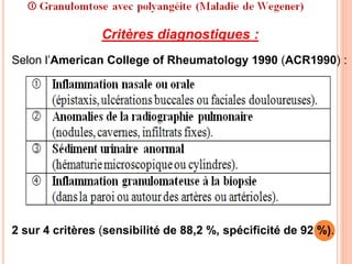 Critères diagnostiques :
Selon l’American College of Rheumatology 1990 (ACR1990) :
2 sur 4 critères (sensibilité de 88,2 %, spécificité de 92 %).
 