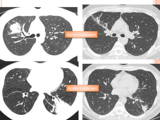 Patiente 52 ans, toux
trainante, asthénie, apyrexie
Il y a quelques semaines,
monoplégie du bras gauche
au réveil, ayant régressé
totalement
Biopsies bronchiques: sur un
des fragments, possible
micro abcès à polynucléaires
neutrophiles au voisinage de
capillaires
Après traitement
Après traitement
 