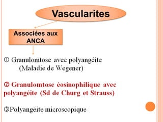Vascularites
Associées aux
ANCA
 