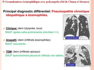 Principal diagnostic différentiel: Pneumopathie chronique
idiopathique à éosinophiles.
 Clinique: idem (dyspnée, toux)
SAUF signes extra-pulmonaires (névrites+++).
 Anapath: idem (infiltrats éosinophiles)
SAUF vascularite.
 TDM: idem (infiltrats apicaux)
SAUF épanchement pleural et infiltrats non labiles.
Churg & Strauss
Carrington
 
