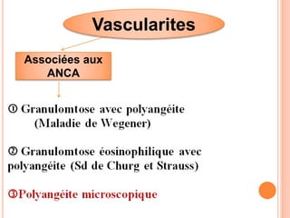 Vascularites
Associées aux
ANCA
 