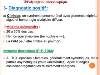 3- Diagnostic positif :
a/ Clinique: un syndrome pneumorénal avec glomérulonéphrite
aiguë et hémorragie alvéolaire diffuse.
Atteinte pulmonaire :
 20 à 30% des cas.
 Hémorragie alvéolaire (hémoptysie ++).
 La PAM peut être limitée au poumon.
Imagerie thoracique (F+P, TDM):
 Au TLX: opacités bilatérales, généralement symétriques, mais
parfois asymétriques (voire unilatérales). Apex et angles
costodiaphragmatiques relativement épargnés.
 
