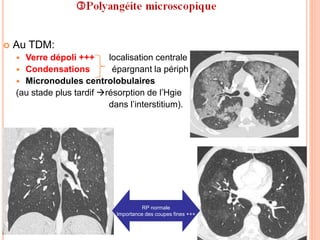  Au TDM:
 Verre dépoli +++ localisation centrale
 Condensations épargnant la périph
 Micronodules centrolobulaires
(au stade plus tardif résorption de l’Hgie
dans l’interstitium).
RP normale
Importance des coupes fines +++
 