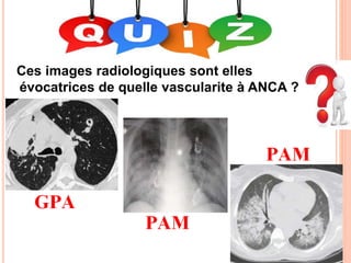 Ces images radiologiques sont elles
évocatrices de quelle vascularite à ANCA ?
 