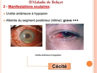 2 - Manifestations oculaires:
 Uvéite antérieure à hypopion
 Atteinte du segment postérieur (rétine): grave +++
Cécité
 