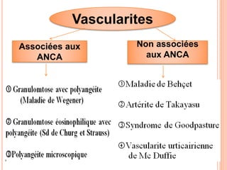 Vascularites
Associées aux
ANCA
Non associées
aux ANCA
 