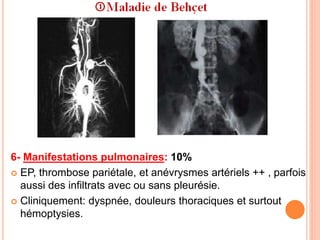 6- Manifestations pulmonaires: 10%
 EP, thrombose pariétale, et anévrysmes artériels ++ , parfois
aussi des infiltrats avec ou sans pleurésie.
 Cliniquement: dyspnée, douleurs thoraciques et surtout
hémoptysies.
 