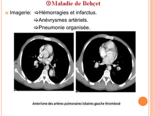  Imagerie: Hémorragies et infarctus.
Anévrysmes artériels.
Pneumonie organisée.
 