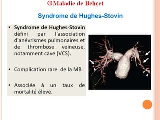 Syndrome de Hughes-Stovin
 