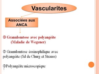 Vascularites
Associées aux
ANCA
 