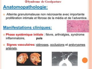 Anatomopathologie:
 Atteinte granulomateuse non nécrosante avec importante
prolifération intimale et fibrose de la média et de l’adventice.
Manifestations cliniques:
 Phase systémique initiale : fièvre, arthralgies, syndrome
inflammatoire, puis
 Signes vasculaires: sténoses, occlusions et anévrysmes
artériels.
 