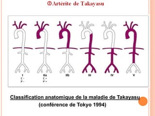 Classification anatomique de la maladie de Takayasu
(conférence de Tokyo 1994)
 