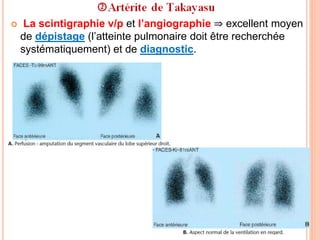  La scintigraphie v/p et l’angiographie ⇒ excellent moyen
de dépistage (l’atteinte pulmonaire doit être recherchée
systématiquement) et de diagnostic.
 
