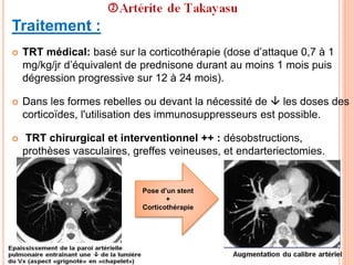 Traitement :
 TRT médical: basé sur la corticothérapie (dose d’attaque 0,7 à 1
mg/kg/jr d’équivalent de prednisone durant au moins 1 mois puis
dégression progressive sur 12 à 24 mois).
 Dans les formes rebelles ou devant la nécessité de  les doses des
corticoïdes, l'utilisation des immunosuppresseurs est possible.
 TRT chirurgical et interventionnel ++ : désobstructions,
prothèses vasculaires, greffes veineuses, et endarteriectomies.
Pose d’un stent
+
Corticothérapie
 