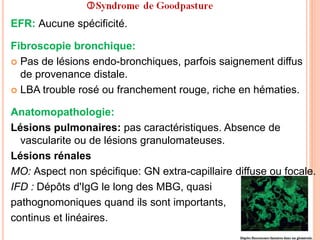 EFR: Aucune spécificité.
Fibroscopie bronchique:
 Pas de lésions endo-bronchiques, parfois saignement diffus
de provenance distale.
 LBA trouble rosé ou franchement rouge, riche en hématies.
Anatomopathologie:
Lésions pulmonaires: pas caractéristiques. Absence de
vascularite ou de lésions granulomateuses.
Lésions rénales
MO: Aspect non spécifique: GN extra-capillaire diffuse ou focale.
IFD : Dépôts d'IgG le long des MBG, quasi
pathognomoniques quand ils sont importants,
continus et linéaires.
 