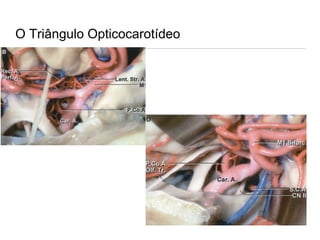 O Triângulo Opticocarotídeo
 