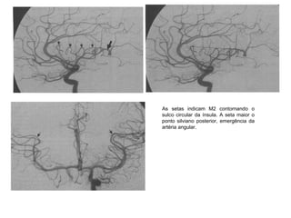 As setas indicam M2 contornando o
sulco circular da ínsula. A seta maior o
ponto silviano posterior, emergência da
artéria angular.
 
