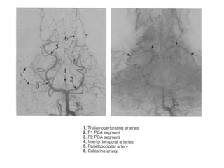 Vascularizacao cerebral