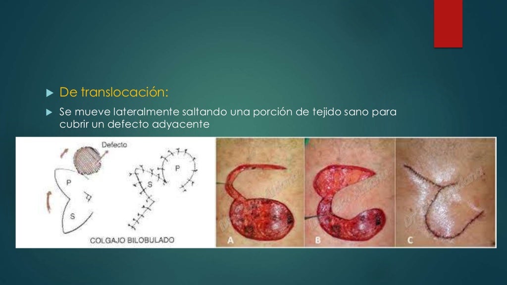 Vascularización cutanea y clasificación de los colgajos