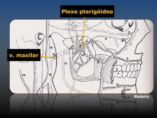 v. maxilar 
Plexo pterigóideo 
Madeira 
 