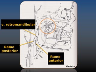 v. retromandibular 
Ramo 
anterior 
Ramo 
posterior 
Madeira 
 