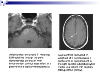 Vascular Lesions of the Brain | PPT