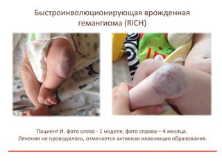 Быстроинволюционирующая врожденная
гемангиома (RICH)
Пациент И. фото слева - 1 неделя, фото справа – 4 месяца.
Лечения не ...