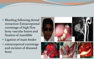  Bleeding following dental
extraction-Extracorporeal
currettage of high flow
bony vascular lesion and
fixation of mandible
 Ligation of main feeder
 extracorporcal currettage
and excision of diseased
bone
 