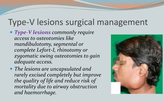 Type-V lesions surgical management
 Type-V lesions commonly require
access to osteotomies like
mandibulotomy, segmental or
complete Lefort-I, rhinotomy or
zygomatic swing osteotomies to gain
adequate access.
 The lesions are uncapsulated and
rarely excised completely but improve
the quality of life and reduce risk of
mortality due to airway obstruction
and haemorrhage.
 