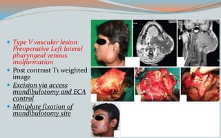  Type V vascular lesion
Preoperative Left lateral
pharyngeal venous
malformation
 Post contrast T1 weighted
image
 Excision via access
mandibulotomy and ECA
control
 Miniplate fixation of
mandibulotomy site
 