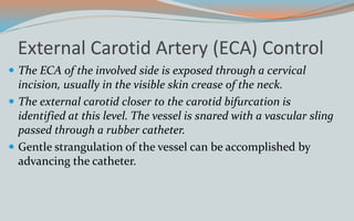 External Carotid Artery (ECA) Control
 The ECA of the involved side is exposed through a cervical
incision, usually in the visible skin crease of the neck.
 The external carotid closer to the carotid bifurcation is
identified at this level. The vessel is snared with a vascular sling
passed through a rubber catheter.
 Gentle strangulation of the vessel can be accomplished by
advancing the catheter.
 