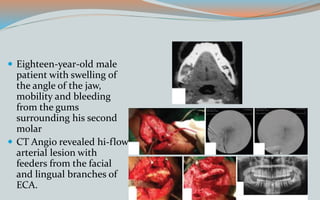  Eighteen-year-old male
patient with swelling of
the angle of the jaw,
mobility and bleeding
from the gums
surrounding his second
molar
 CT Angio revealed hi-flow
arterial lesion with
feeders from the facial
and lingual branches of
ECA.
 