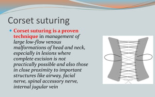 Corset suturing
 Corset suturing is a proven
technique in management of
large low-flow venous
malformations of head and neck,
especially in lesions where
complete excision is not
practically possible and also those
in close proximity to important
structures like airway, facial
nerve, spinal accessory nerve,
internal jugular vein
 