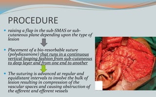 PROCEDURE
 raising a flap in the sub-SMAS or sub-
cutaneous plane depending upon the type of
lesion
 Placement of a bio-resorbable suture
(polydiaxanone) that runs in a continuous
vertical looping fashion from sub-cutaneous
to deep layer and from one end to another
 The suturing is advanced at regular and
equidistant intervals to involve the bulk of
lesion resulting in compression of the
vascular spaces and causing obstruction of
the afferent and efferent vessels
 