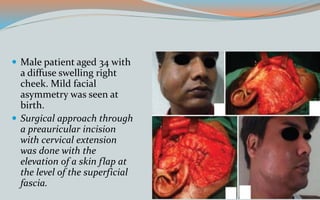  Male patient aged 34 with
a diffuse swelling right
cheek. Mild facial
asymmetry was seen at
birth.
 Surgical approach through
a preauricular incision
with cervical extension
was done with the
elevation of a skin flap at
the level of the superficial
fascia.
 