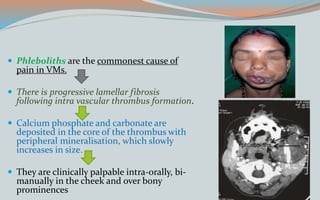  Phleboliths are the commonest cause of
pain in VMs.
 There is progressive lamellar fibrosis
following intra vascular thrombus formation.
 Calcium phosphate and carbonate are
deposited in the core of the thrombus with
peripheral mineralisation, which slowly
increases in size.
 They are clinically palpable intra-orally, bi-
manually in the cheek and over bony
prominences
 