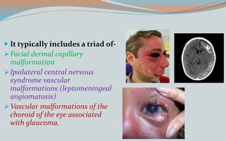  It typically includes a triad of-
Facial dermal capillary
malformation
Ipsilateral central nervous
syndrome vascular
malformations (leptomeningeal
angiomatosis)
Vascular malformations of the
choroid of the eye associated
with glaucoma.
 