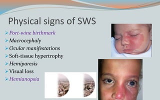 Physical signs of SWS
Port-wine birthmark
Macrocephaly
Ocular manifestations
Soft-tissue hypertrophy
Hemiparesis
Visual loss
Hemianopsia
 