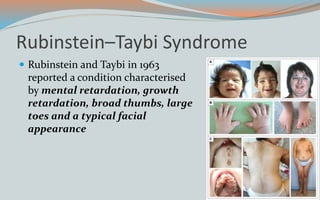 Rubinstein–Taybi Syndrome
 Rubinstein and Taybi in 1963
reported a condition characterised
by mental retardation, growth
retardation, broad thumbs, large
toes and a typical facial
appearance
 