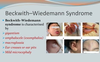 Beckwith–Wiedemann Syndrome
 Beckwith–Wiedemann
syndrome is characterised
by
gigantism
omphalocele (exomphalos)
macroglossia
Ear creases or ear pits
Mild microcephaly
 