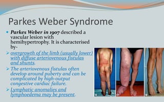 Parkes Weber Syndrome
 Parkes Weber in 1907 described a
vascular lesion with
hemihypertrophy. It is characterised
by-
overgrowth of the limb (usually lower)
with diffuse arteriovenous fistulas
and shunts.
The arteriovenous fistulas often
develop around puberty and can be
complicated by high-output
congestive cardiac failure.
Lymphatic anomalies and
lymphoedema may be present.
 