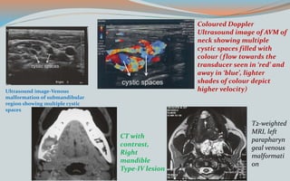 Ultrasound image-Venous
malformation of submandibular
region showing multiple cystic
spaces
Coloured Doppler
Ultrasound image of AVM of
neck showing multiple
cystic spaces filled with
colour (flow towards the
transducer seen in ‘red’ and
away in ‘blue’, lighter
shades of colour depict
higher velocity)
CT with
contrast,
Right
mandible
Type-IV lesion
T2-weighted
MRI, left
parapharyn
geal venous
malformati
on
 
