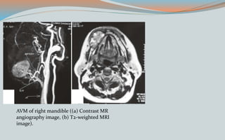 AVM of right mandible ((a) Contrast MR
angiography image, (b) T2-weighted MRI
image).
 