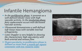 Infantile Hemangioma
 In the proliferative phase, it presents as a
well-defined lobular mass with high
vascular activity. In the involuting phase,
fatty replacement occurs with decreased
vascular activity.
 Ultrasound demonstrates a well-defined
soft tissue mass with variable internal
echogenicity.
 Color Doppler is very helpful in showing
the characteristic high vascularity with
both arterial and venous flow.
 Hypervascularity in proliferative phase is
defined as more than 5 vessels per square
centimeter with low resistive index
hyperechoic subcutaneous soft
tissue mass overlying the right
lambdoid suture
 